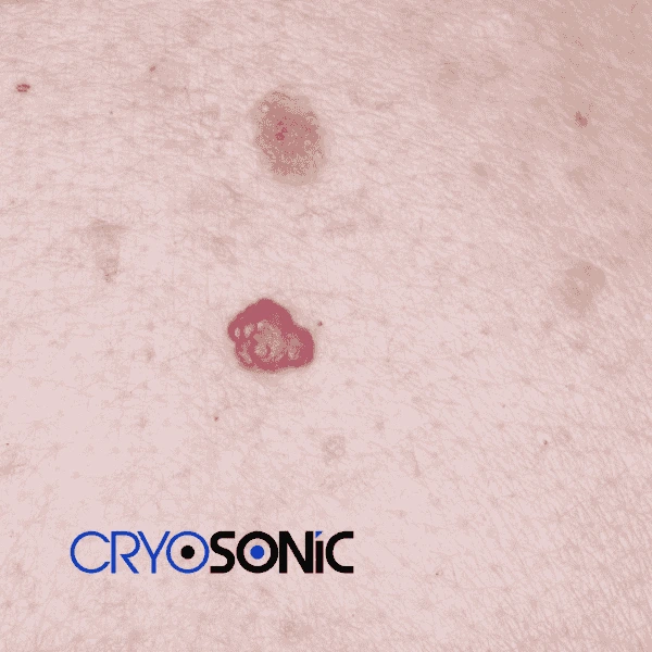 Looking for pain free cherry angioma removal treatment Christchurch? Call our team today! Christchurch