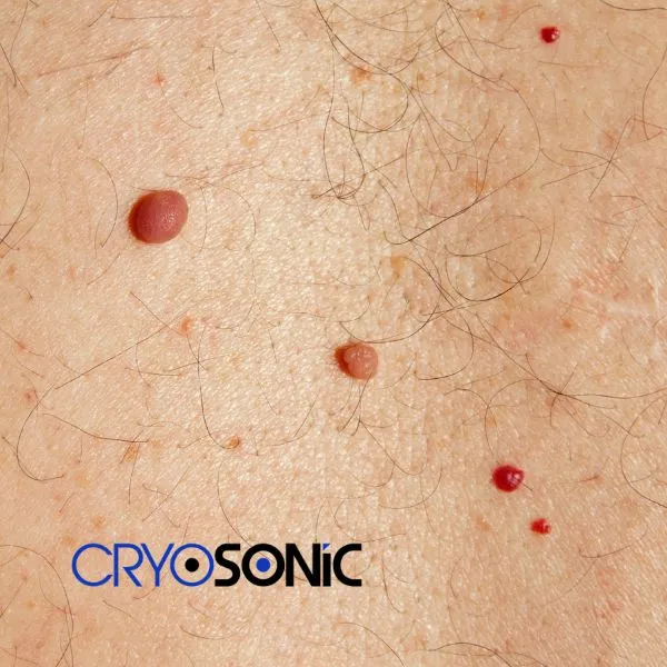 get cherry angioma removal treatment today! Christchurch