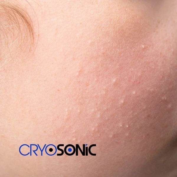 Are you looking for milia removal treatment? Contact our team today Christchurch