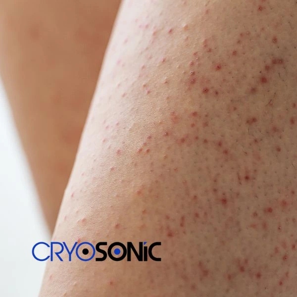 Looking for Seborrhoeic Keratosis removal Christchurch treatment? Call our consultants today in Christchurch