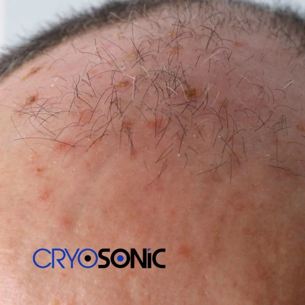 Access Seborrhoeic Keratosis removal from the comfort of your own home! Call us today in Christchurch
