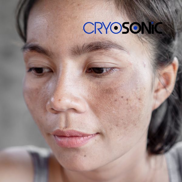 Ready to start age spots removal? Contact our team today in Christchurch