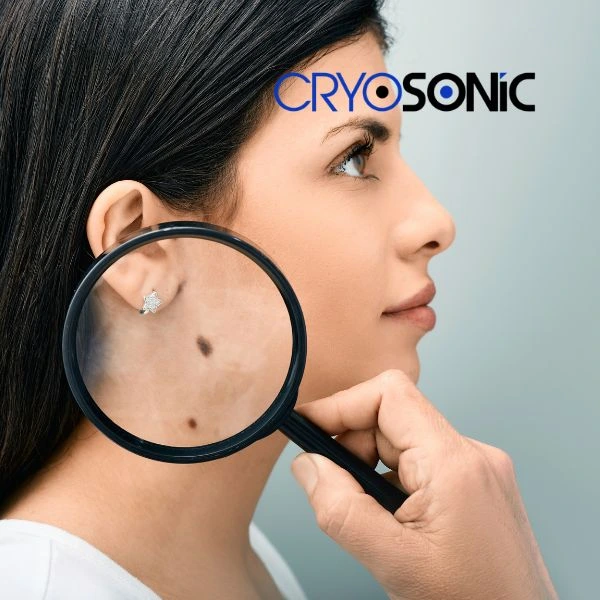 Do you want to learn more about benign moles removal treatment? Call our team today Christchurch