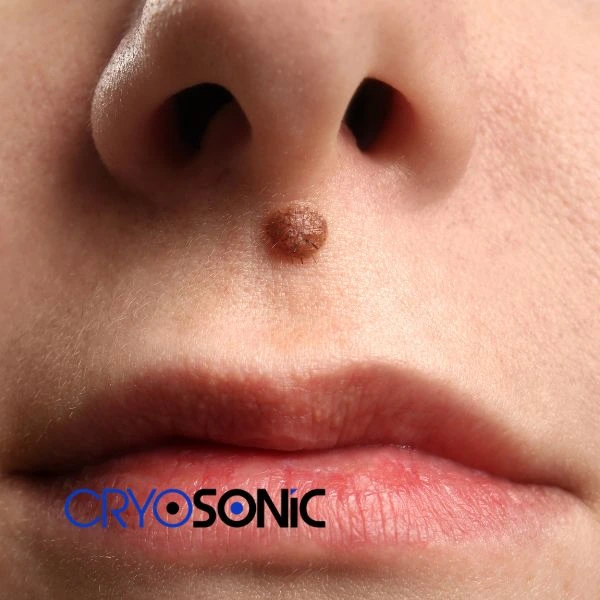 Start your benign moles removal treatment today Christchurch