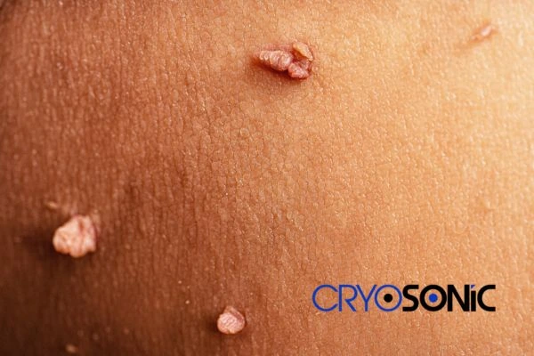 What Can You Expect During and After Your Cryosonic Treatment Christchurch