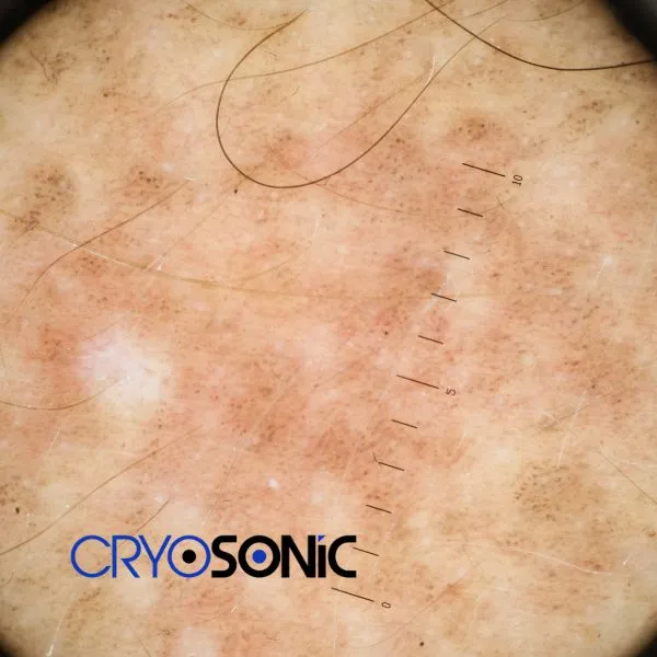 Speak to our team today about sun damaged skin treatment today in Christchurch