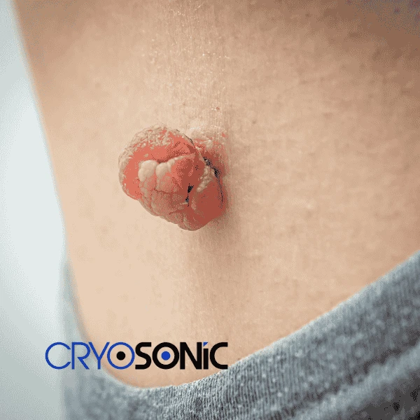 Book your skin tags removal Christchurch from comfort of your own home! Christchurch