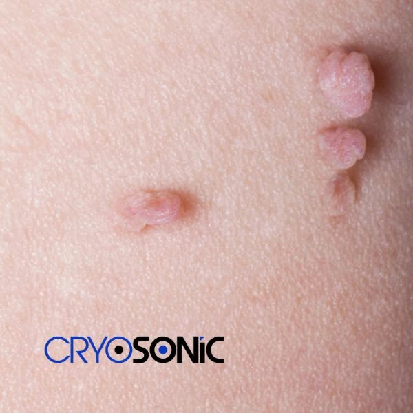 Are you looking for fast effect skin tag removal Christchurch? Book in NOW! Christchurch