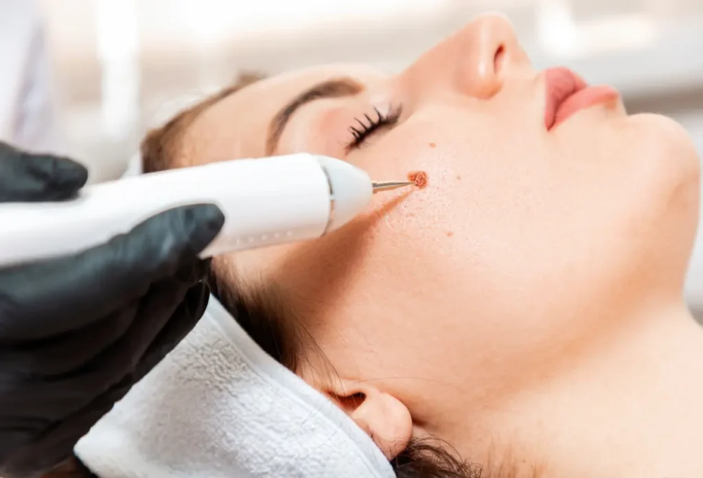 CryoPen Accuracy Christchurch being used to safely and precisely remove multiple skin lesions, illustrating answers to common patient FAQs Christchurch