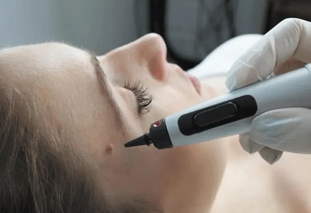 CryoPen accurately targeting skin lesions with millimetre-precision for safe and effective removal by Cryosonic Christchurch