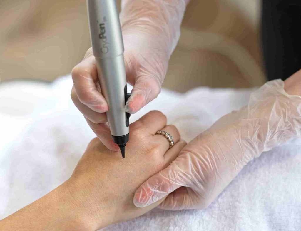 CryoPen Accuracy Christchurch in action, precisely targeting a skin lesion to ensure safe treatment and protect surrounding healthy skin Christchurch