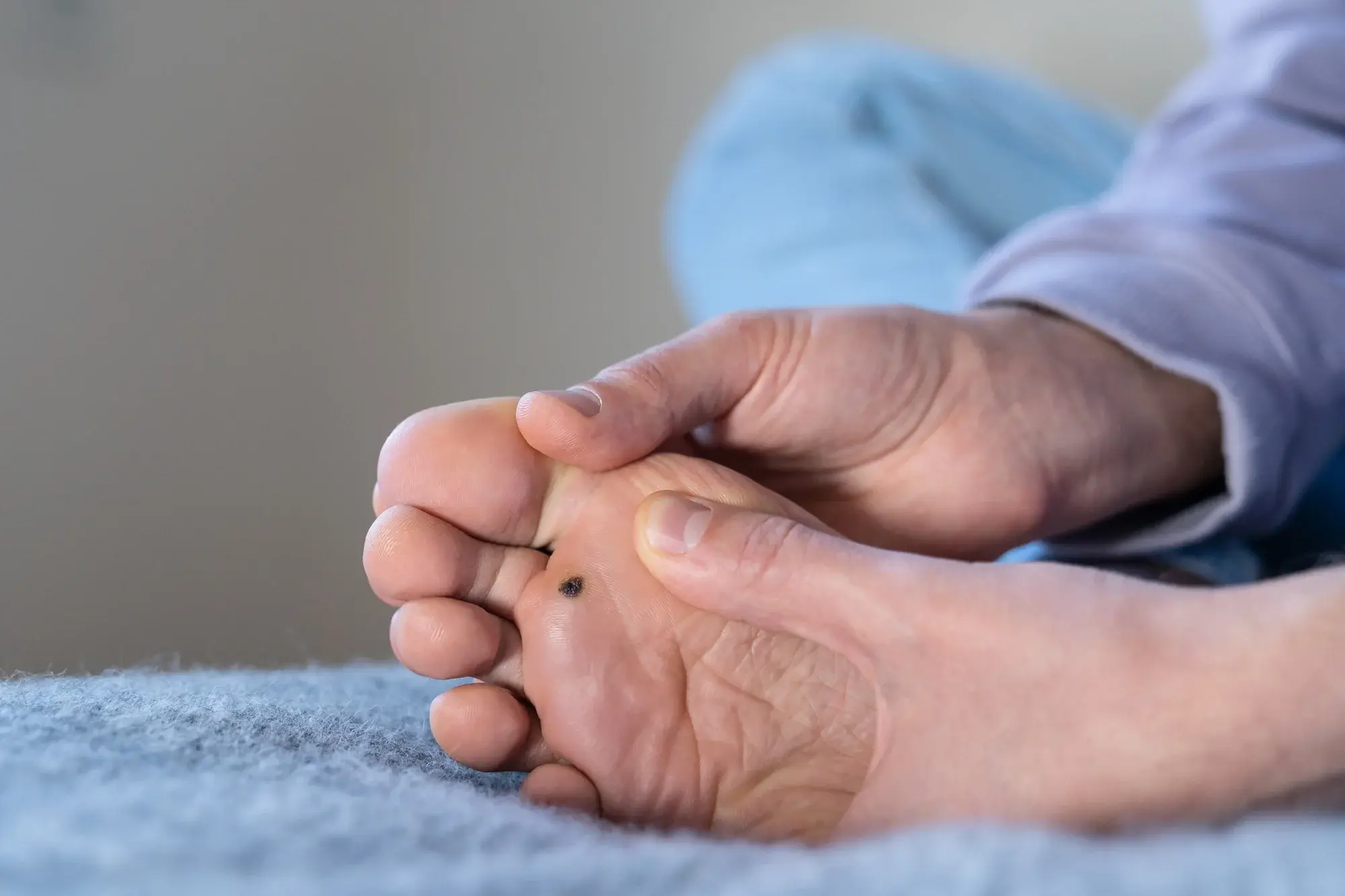 CryoPen treatment for multiple and stubborn Plantar Warts (Verrucae) Christchurch, showing safe, precise removal and patient-friendly procedure Christchurch