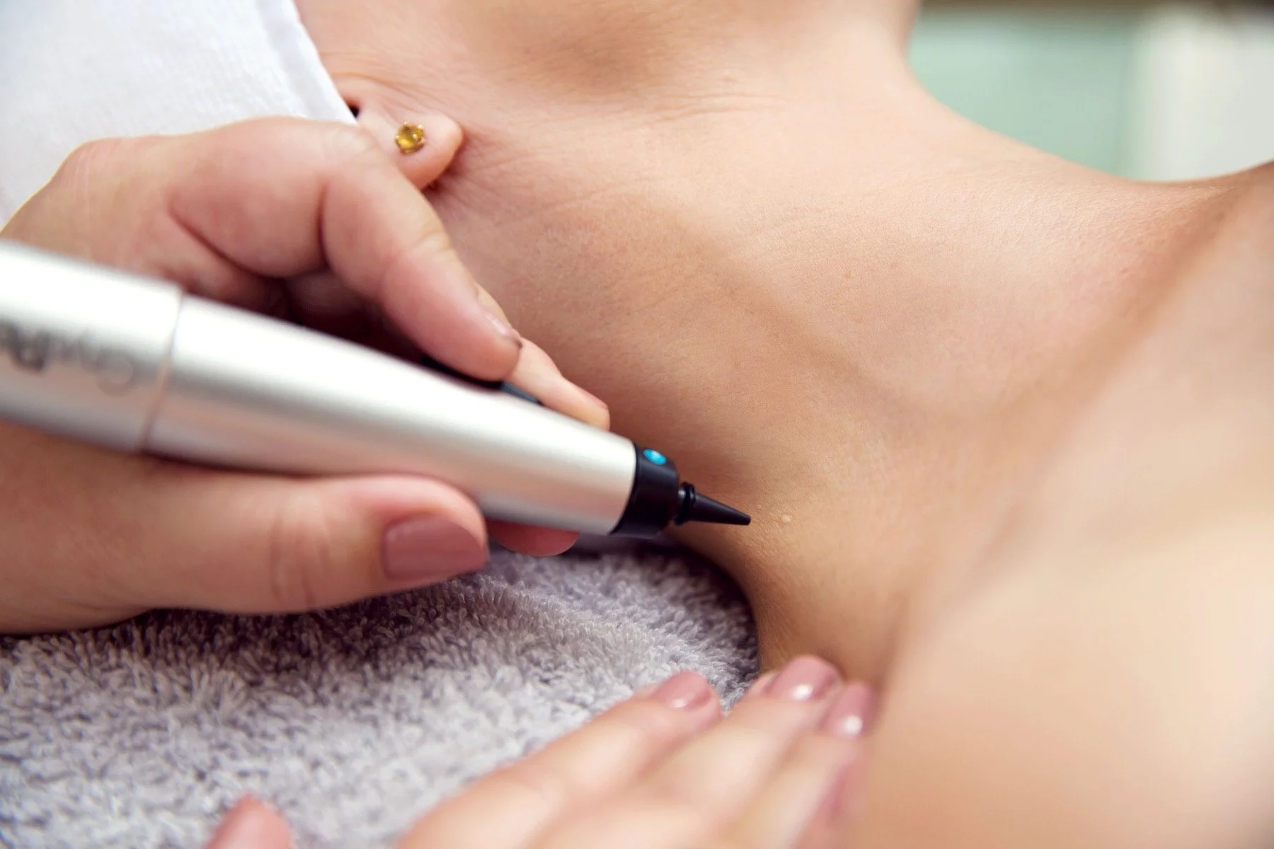 CryoPen Christchurch precisely treating Molluscum Contagiosum lesions, showing safe and effective removal for faster healing by Cryosonic Christchurch