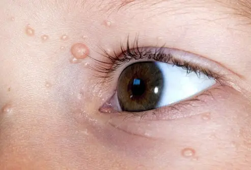 CryoPen treating persistent Molluscum Contagiosum Christchurch lesions Christchurch