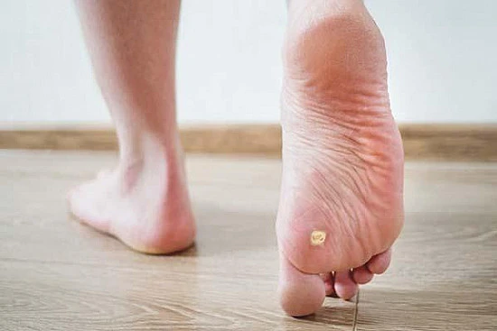 CryoPen treatment removing stubborn Plantar Warts (Verrucae) for precise, safe, and effective relief from resistant lesions Christchurch