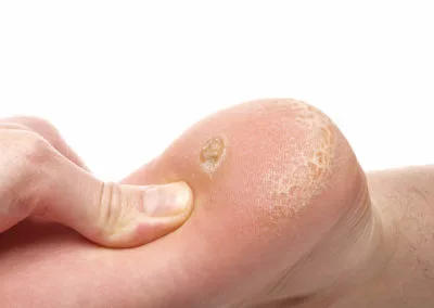 Painful Plantar Warts (Verrucae) Christchurch, highlighting how stubborn warts affect everyday activities and comfort Christchurch