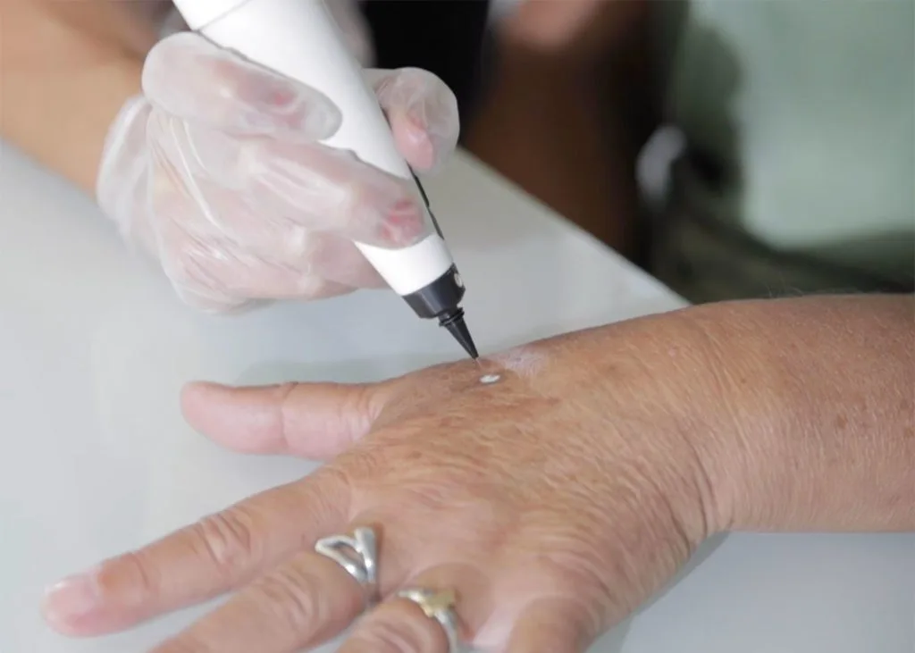 Close-up of CryoPen accuracy Christchurch targeting a skin lesion, showing why precision matters for safe and effective removal Christchurch