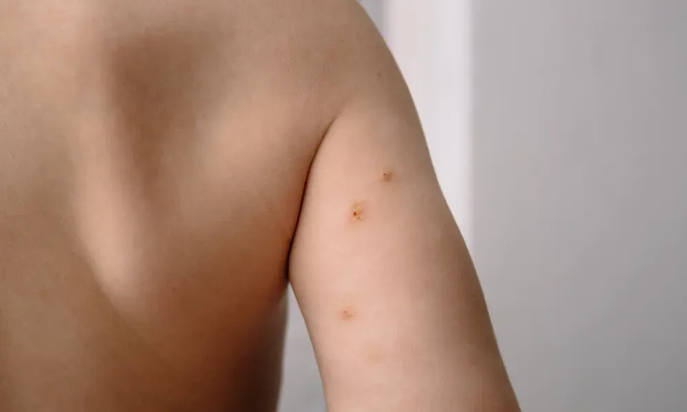 CryoPen treating Molluscum Contagiosum Christchurch professionally, highlighting safe and precise lesion removal for improved skin and confidence Christchurch
