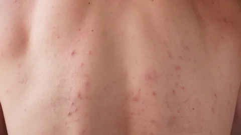 CryoPen treating Christchurch Molluscum Contagiosum lesions safely and precisely, illustrating answers to common patient FAQs Christchurch